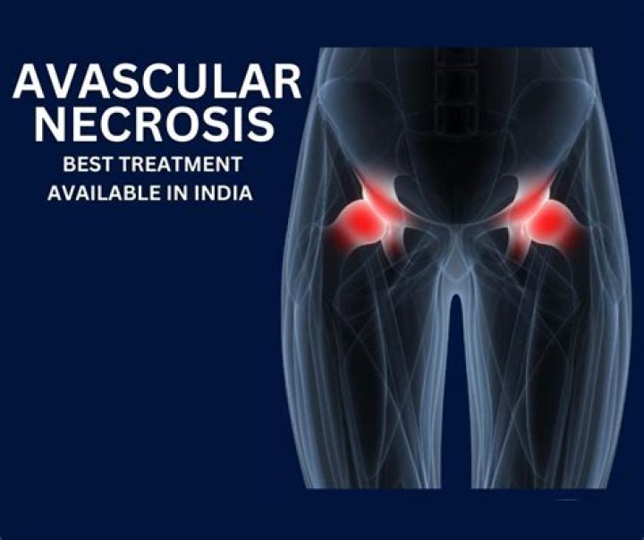 What can mimic avascular necrosis?