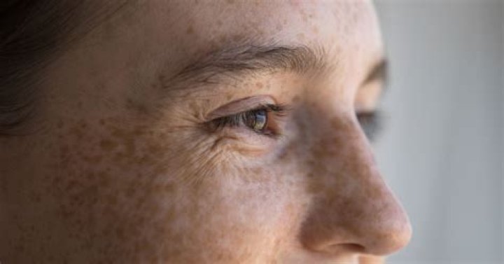 What is the main cause of hyperpigmentation?