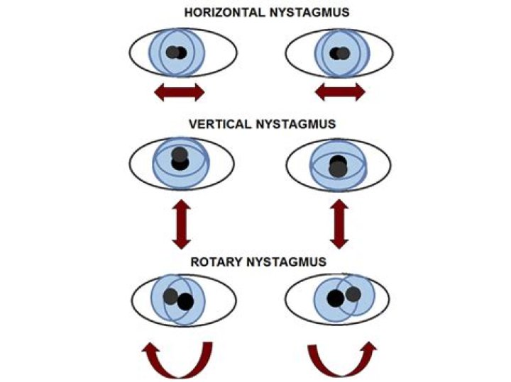 Why does it hurt to move my eyes?
